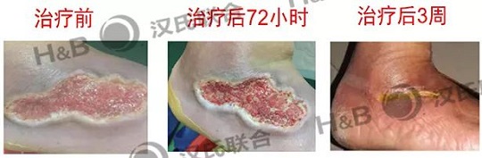 糖尿病足治療
