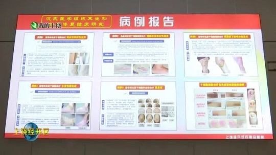 干細(xì)胞治療創(chuàng)面修復(fù)