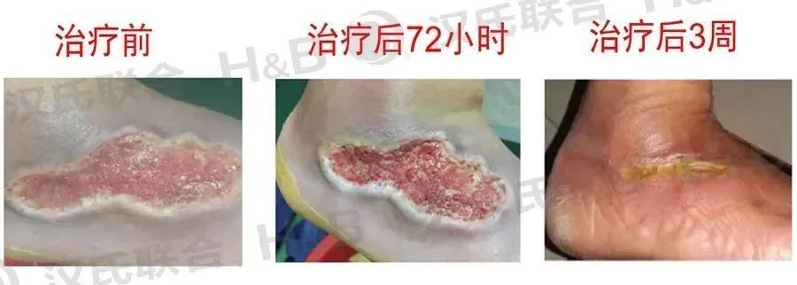 糖尿病治療選漢氏聯(lián)合